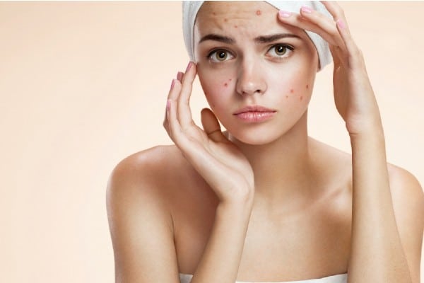 tratamientos para el acne severo