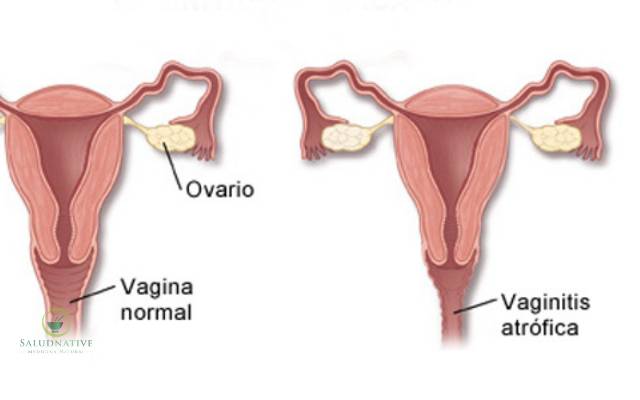 vulvovaginitis atrófica